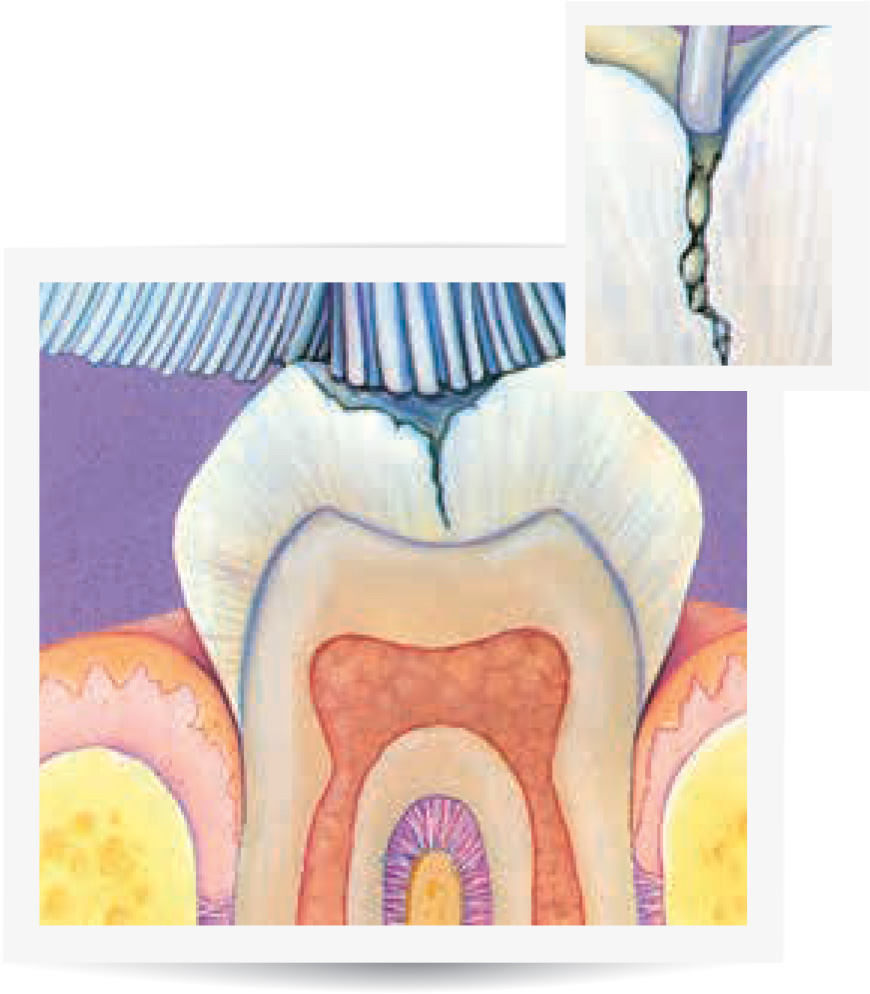 Pit and Fissure Sealants Impressions Dental Centres